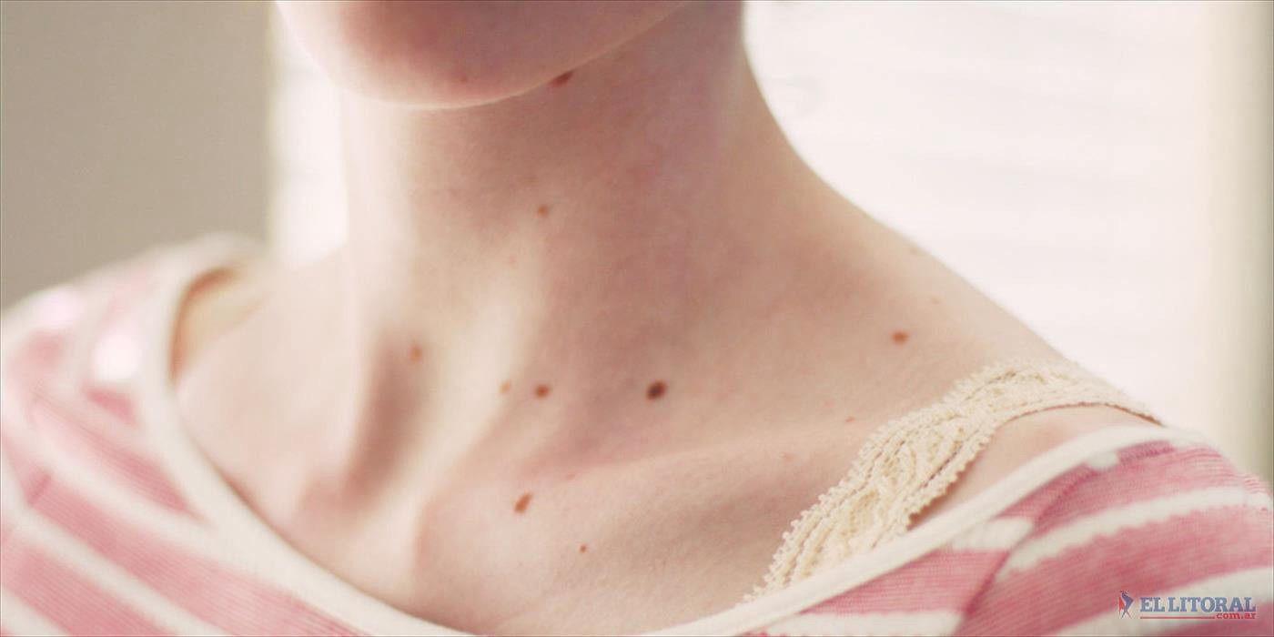 Hasta el viernes se realizan controles gratuitos para la detección precoz de cáncer de piel | Información General