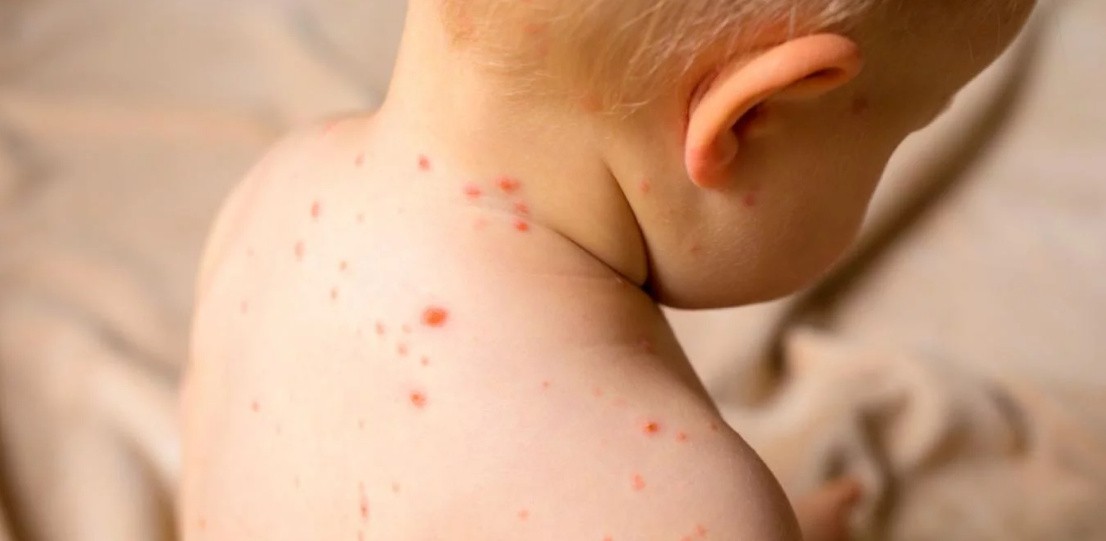 Recomiendan la vacunación contra el sarampión ante los brotes en la región | Información General