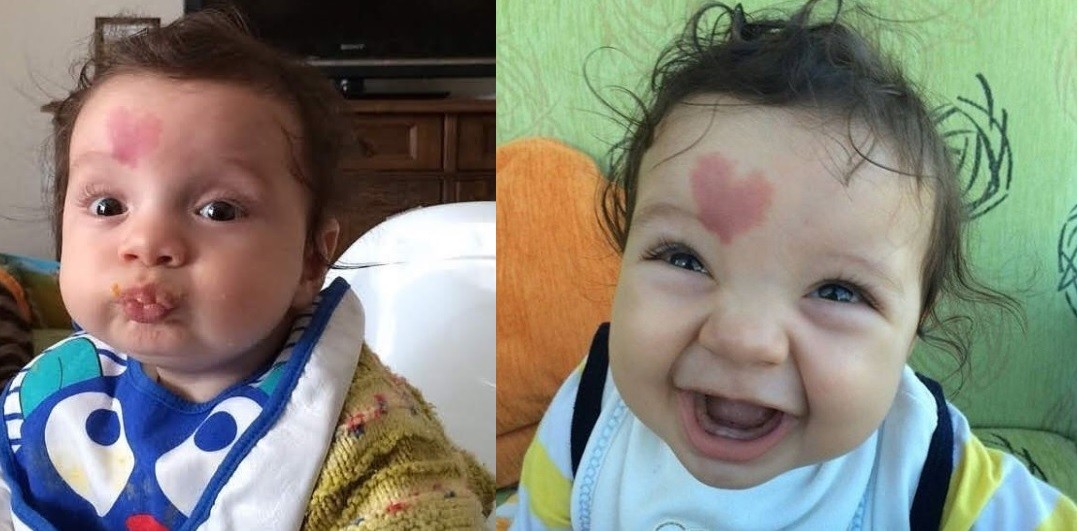 Furor mundial por "Baby Love" el niño que nació con un corazón en la frente | Tecnología