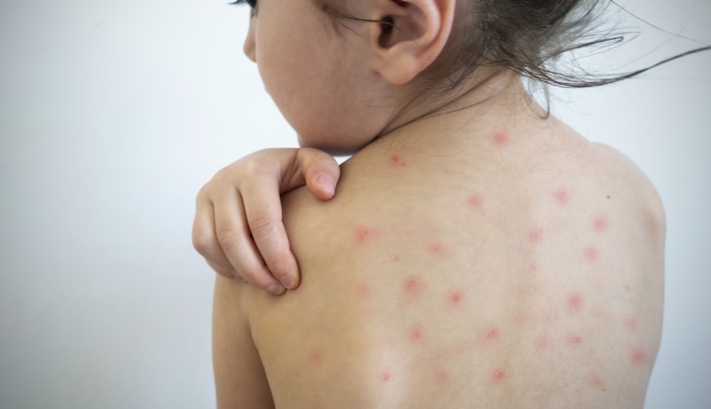 Confirman 142 casos de sarampión en la provincia de Buenos Aires | Información General