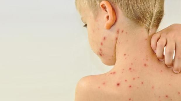 Argentina anunció que controló el brote de sarampión | Información General