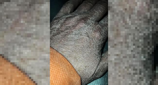 Se viralizó la imagen de la mano de una enfermera luego de horas de trabajo | Tecnología