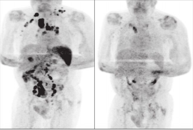 Investigan el caso de un hombre que se curó de cáncer tras contagiarse coronavirus | Información General