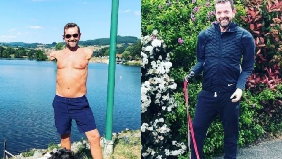 El testimonio del hombre que recibió el primer trasplante de brazos y hombros de la historia | Tecnología