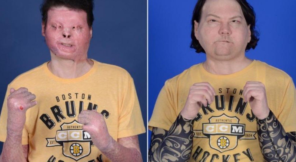 Primer trasplante de cara y manos en simultáneo | Internacionales