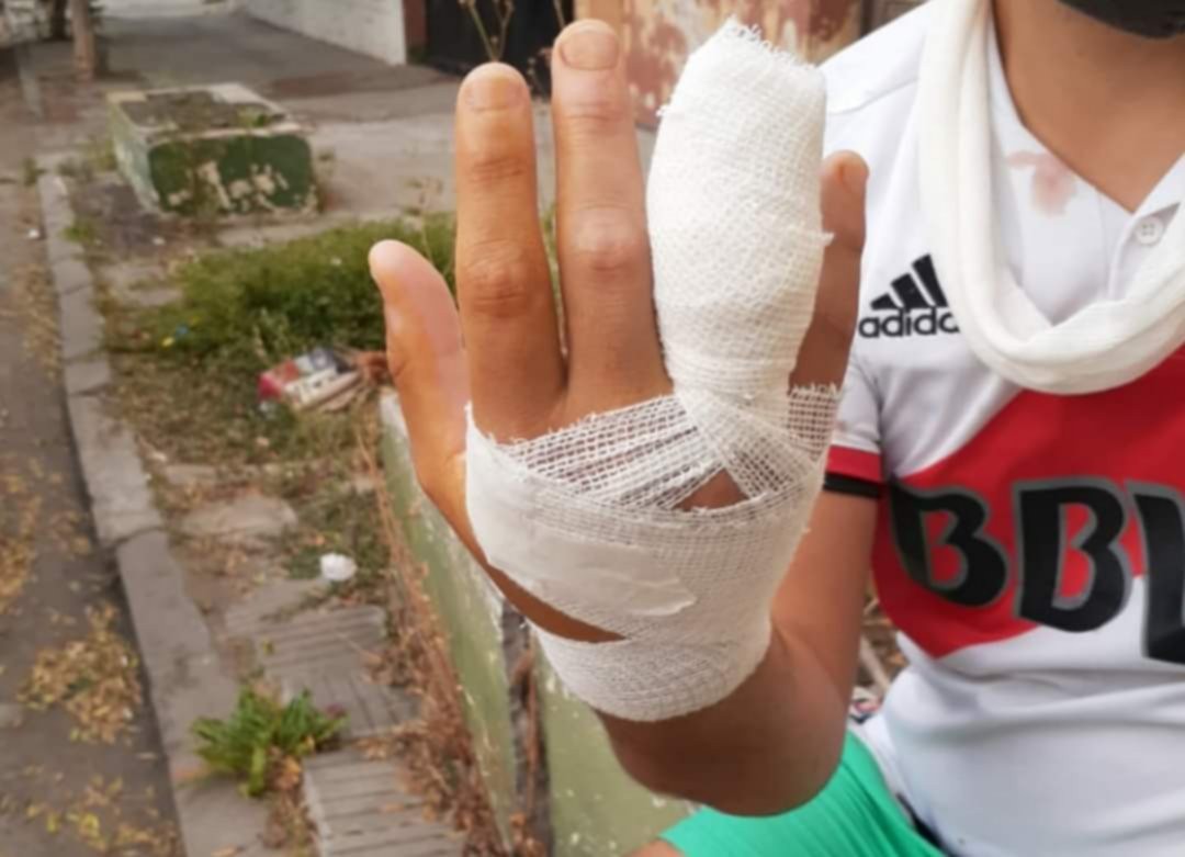 Viedma: un joven se metió en una pelea de perros y perdió una falange | Información General