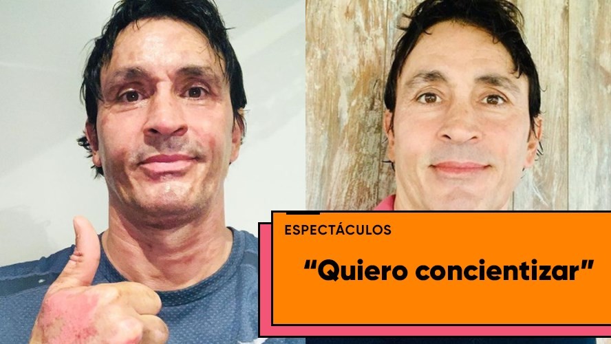 Sebastián Estevanez mostró las fotos de su rostro quemado | Espectáculos