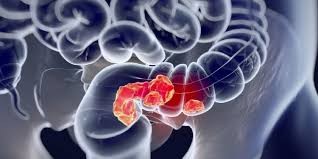 Día Mundial de la Prevención del Cáncer de Colon y Recto: prevención y control a partir de los 50 años para reducir casos | Información General