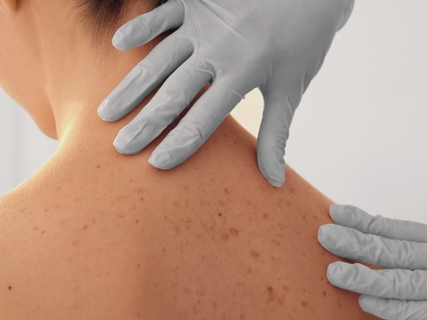 Presentan tecnología israelí para diagnosticar cáncer de piel en segundos | Tecnología