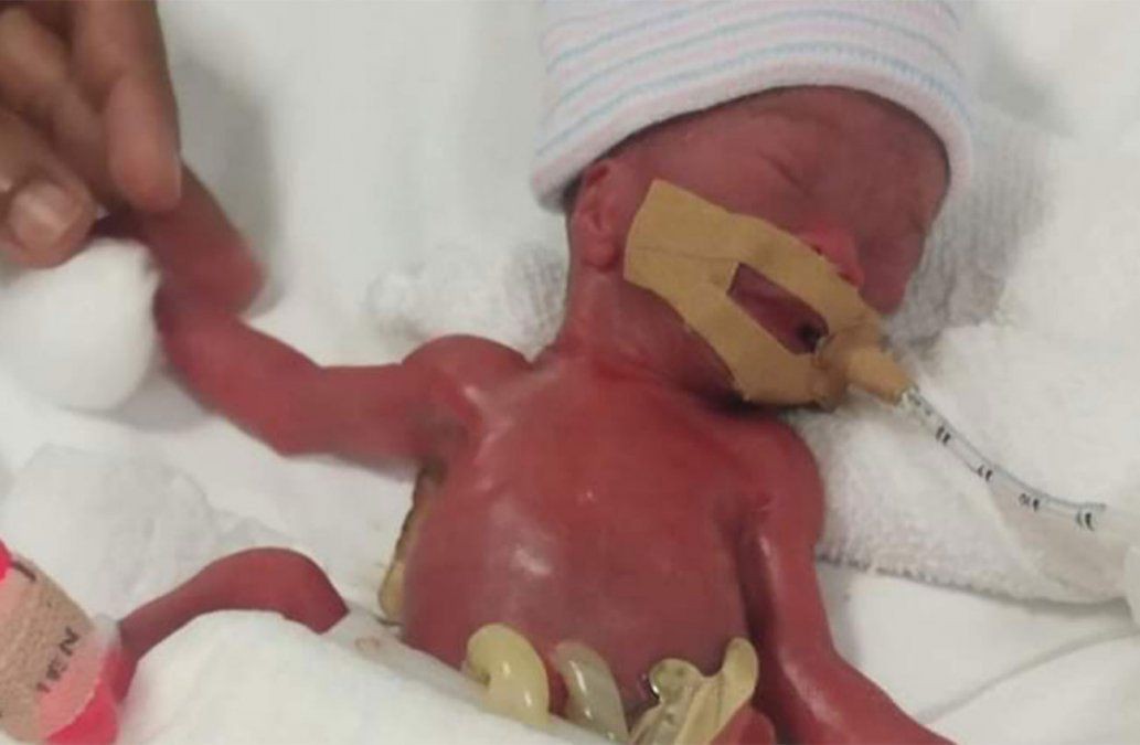 Luego de un año, dan de alta y se va a su casa la beba prematura "más pequeña del mundo" | Internacionales