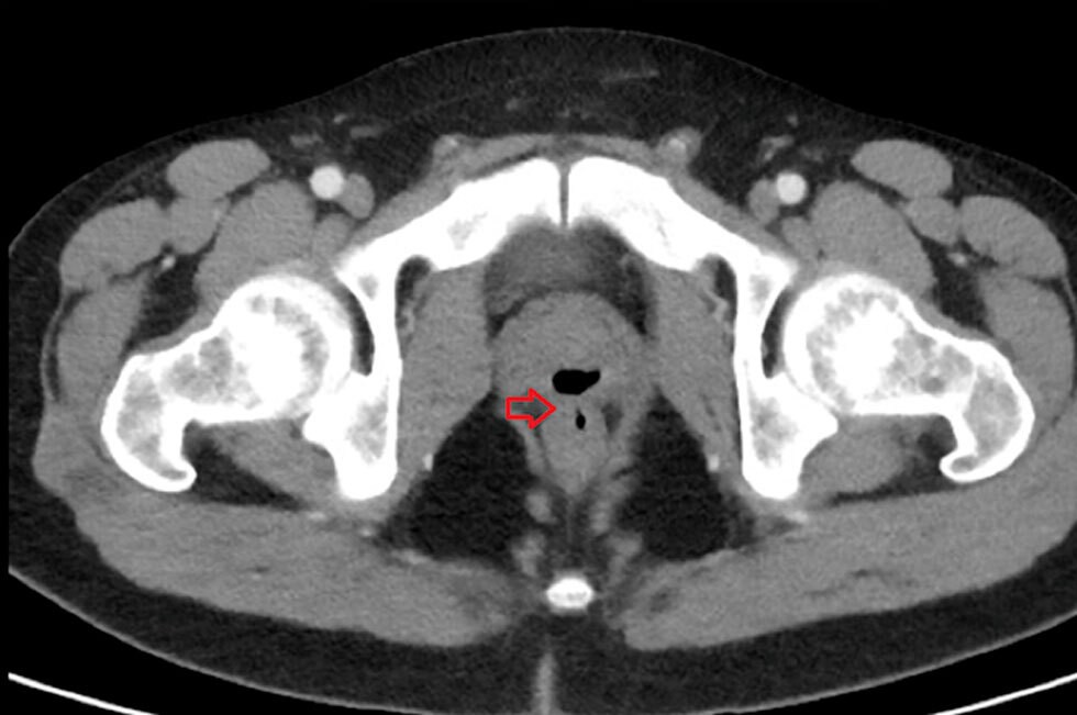 Médicos descubrieron que un hombre eyaculó por el ano durante más de dos años | Tecnología