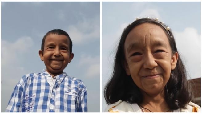 La historia de "los hermanos Benjamin Button": dos nenes que aparentan tener 80 a causa de una rara enfermedad | Tecnología