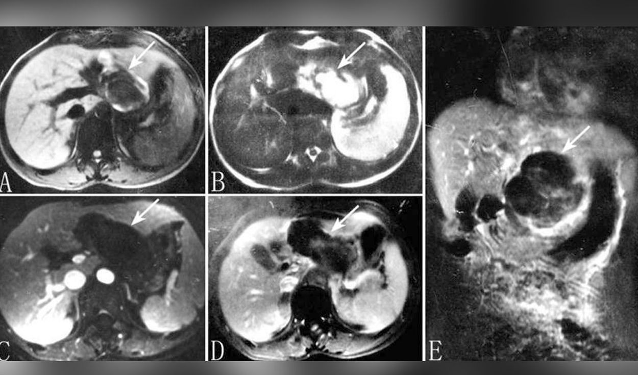 "Jamás vi algo así": un pediatra atendió a una mujer embarazada con el feto en el hígado | Internacionales