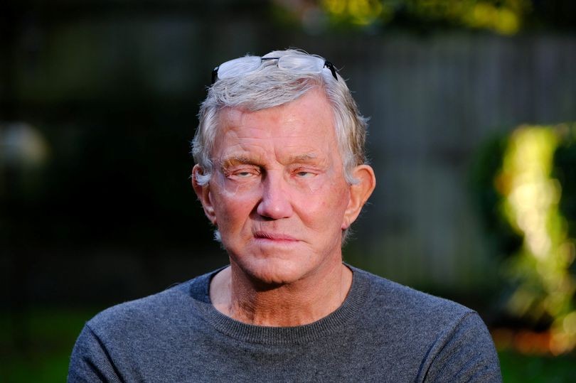 Un hombre lleva tres años sin poder cerrar los ojos tras cirugía plástica fallida | Tecnología