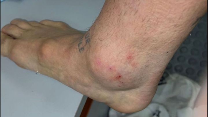 La impactante foto del tobillo del "Papu" Gómez tras el duelo con Chile | Deportes