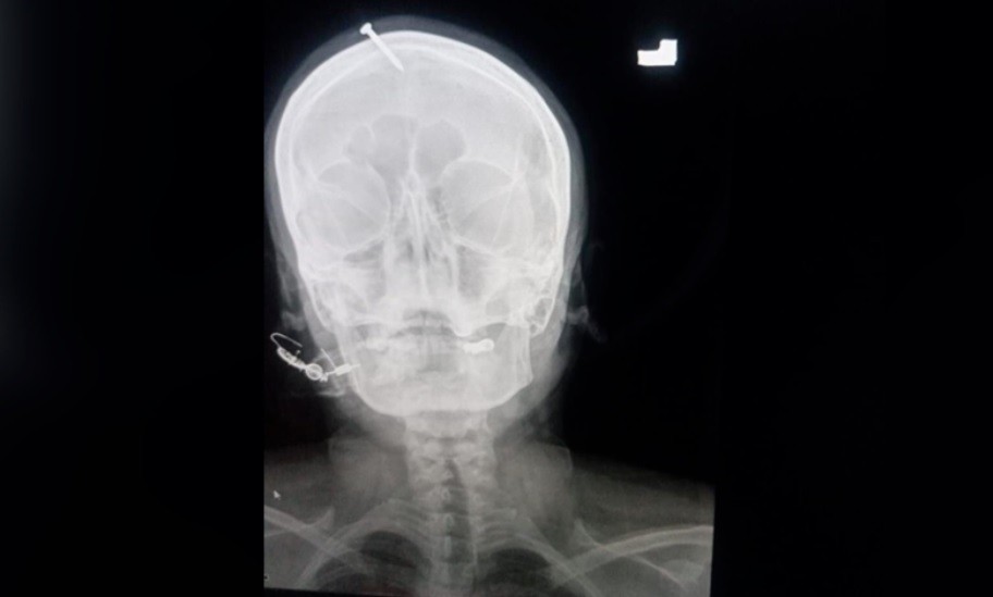 Curandero le puso un clavo en la cabeza a una embarazada para garantizarle que tenga un varón | Internacionales