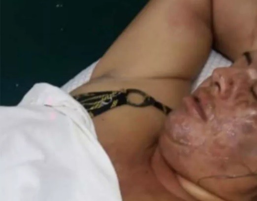 Hombre le tiró agua hirviendo a su pareja: "Tiene el 80% del rostro quemado" | Información General