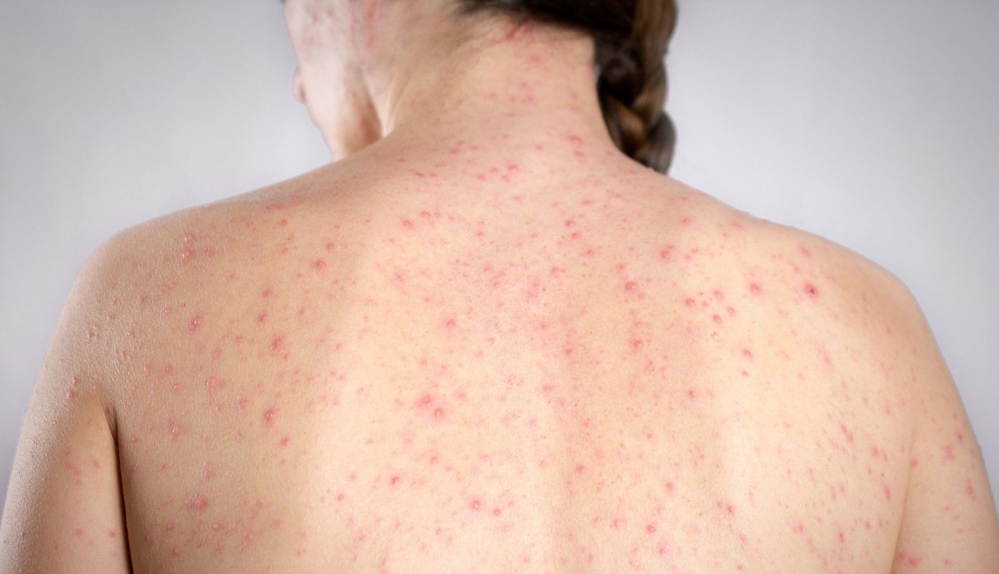 Alerta epidemiológico: El Ministerio de Salud informó un "posible caso" de sarampión en CABA | Información General