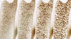 Osteoporosis: en Argentina se producen 90 fracturas de cadera por día | Información General