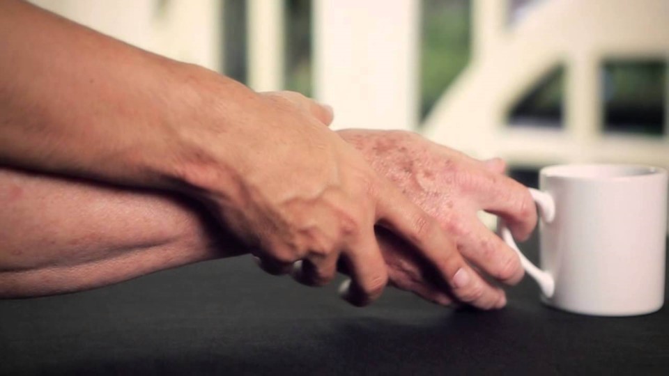 Unas cien mil personas viven en Argentina con Parkinson | Tecnología