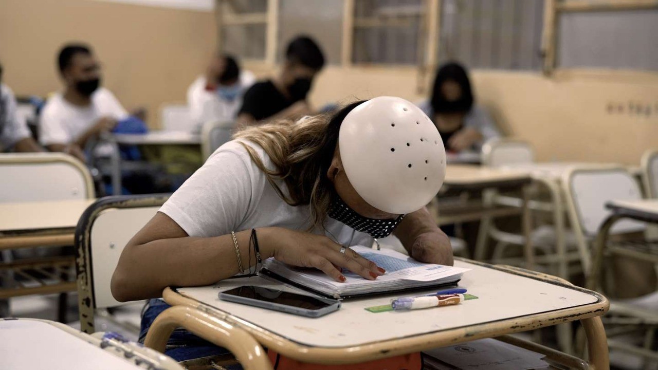 Historia de superación: tiene 22 años, vive con el 88% del cuerpo quemado y no se rinde | Información General