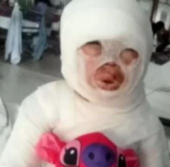 Una empleada de un restaurante se tropezó y le volcó aceite hirviendo a una nena de 3 años | Información General