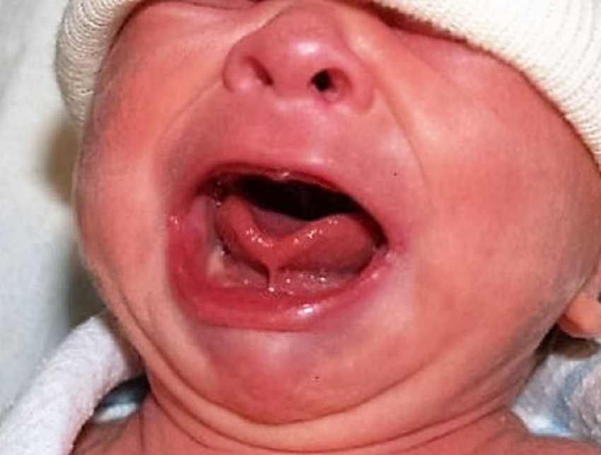 La moda de cortar el frenillo de la lengua de los bebés para favorecer la lactancia | Tecnología