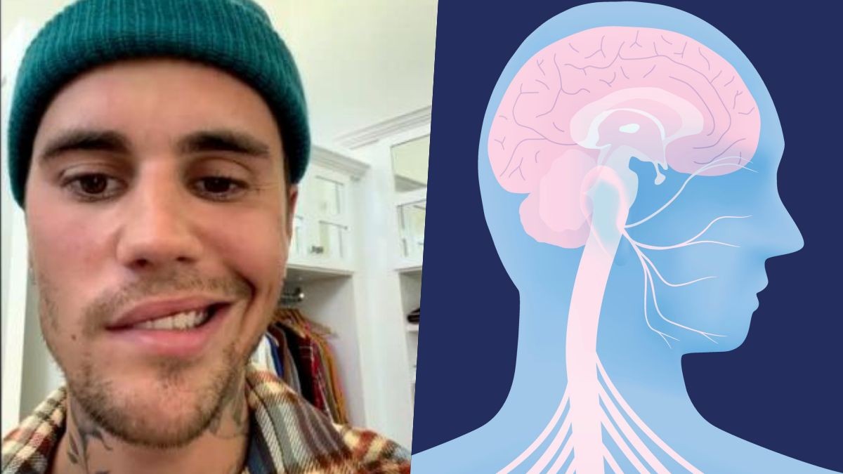 Qué es el Síndrome de Ramsay Hunt, la patología que le provocó parálisis facial a Justin Bieber | Información General