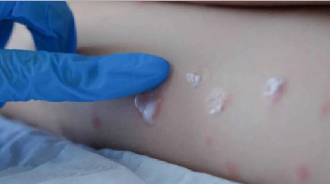 Confirman el primer caso de viruela del mono en Mendoza | Información General