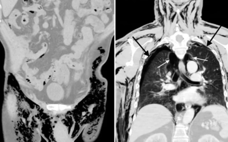 "Escroto silbante": tras una operación, le sonaban los testículos y casi le cuesta la vida | Internacionales