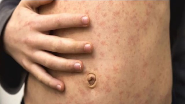 Emergencia Sanitaria Internacional por la viruela del mono: cómo es la situación en Argentina | Información General