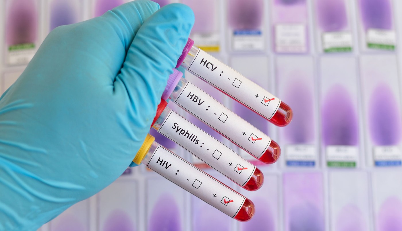 Enfermedades de transmisión sexual: un antibiótico reduce el contagio en casos de sexo sin preservativo | Internacionales