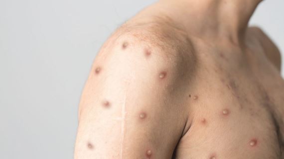 Viruela del mono: ya hay 24 casos confirmados en el país | Información General