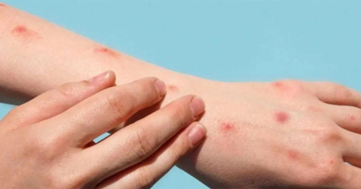 Confirmaron el primer caso de viruela símica en la capital provincial | Información General