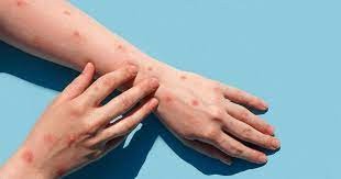 Confirmaron un nuevo caso de Viruela Símica en Rosario | Rosario y la región