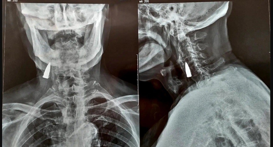Tras sufrir una caída en su balcón, fue al hospital y descubrieron que tenía una bala en el cuello | Tecnología