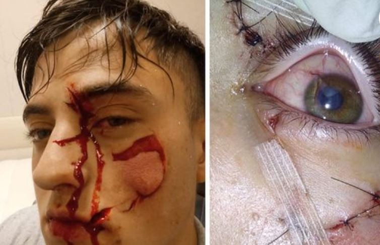 Vio a un amigo hablando con su ex novia y lo desfiguró: "¿Qué voy a hacer? Me cegué" | Información General