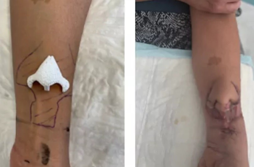 Injertaron la nariz en el brazo a una mujer para que recupere su olfato tras sufrir un cáncer | Tecnología