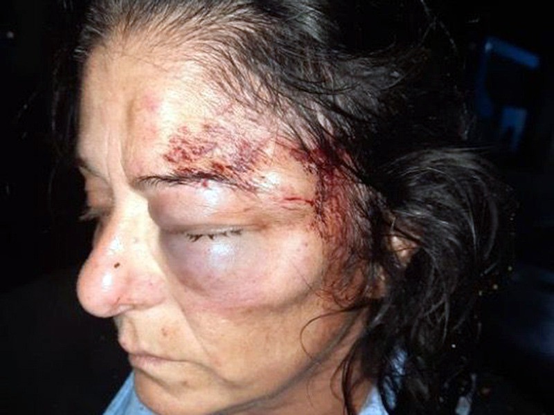 Desfiguraron a colectivera con brutal golpiza durante un robo | Rosario y la región