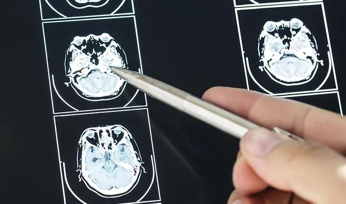 Cada día se detectan en Argentina 5 casos de tumores cerebrales: ¿cuáles son los signos de alerta? | Información General