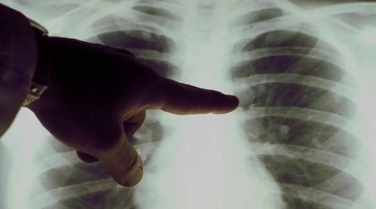 Presentan en la Argentina un nuevo tratamiento para un tipo de cáncer de pulmón | Información General