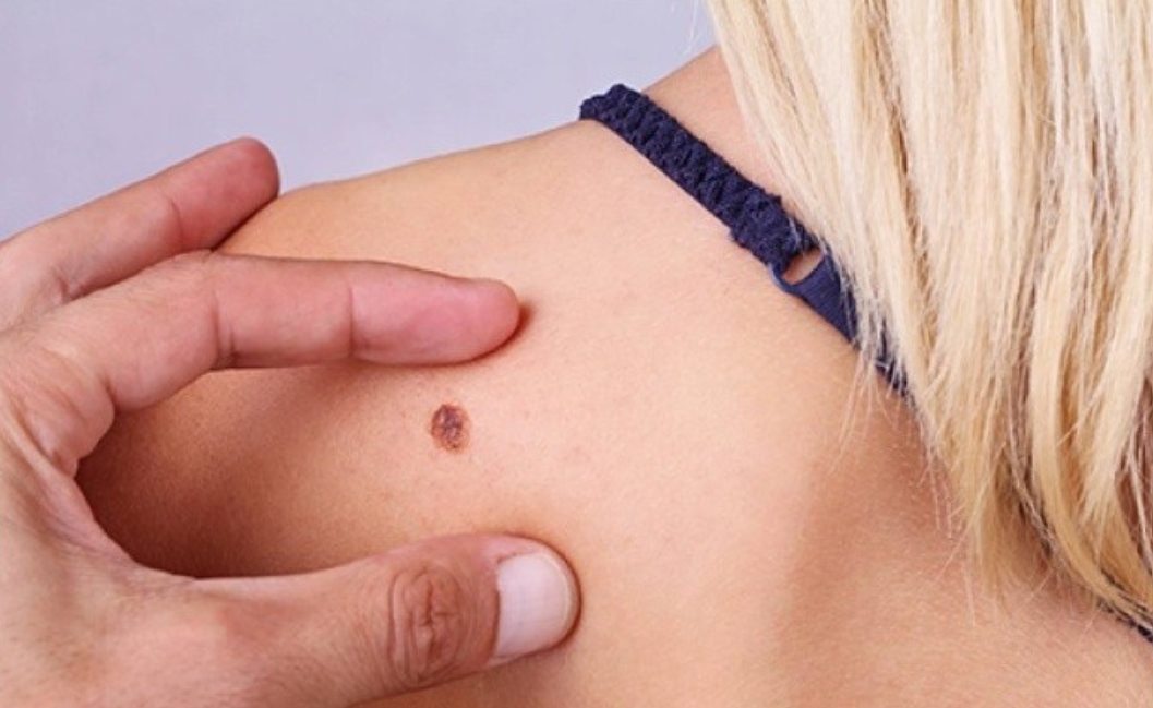 Melanoma: se diagnostican más de 1.600 casos cada año en Argentina | Información General