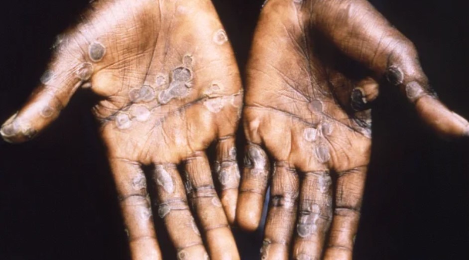 Emergencia global por la viruela del mono: cuántos casos confirmados hay en la Argentina | Información General