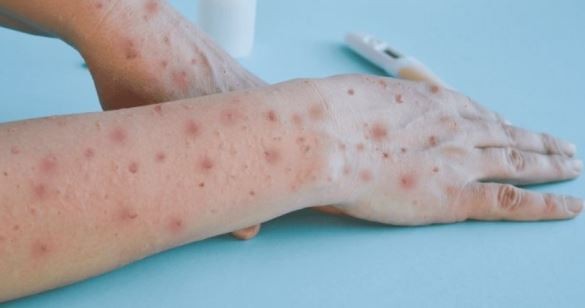 Identificaron 22 casos de la viruela del mono en la Argentina | Información General