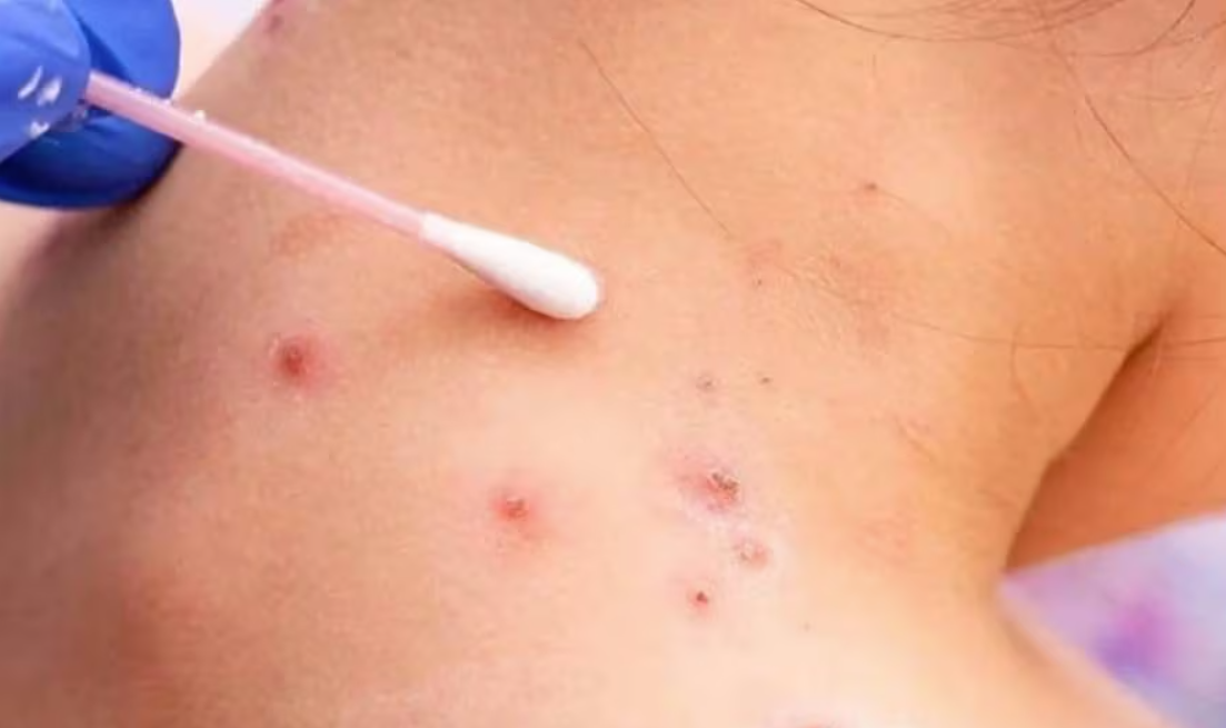 Se detectaron más de 20 casos de viruela del mono en Argentina | Información General