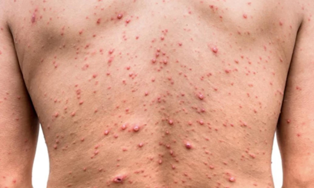 Detectaron siete nuevos casos de viruela del mono en Argentina | Información General