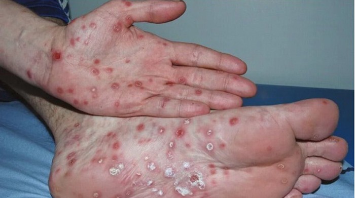 Preocupa un fuerte brote de sífilis en Argentina | Información General