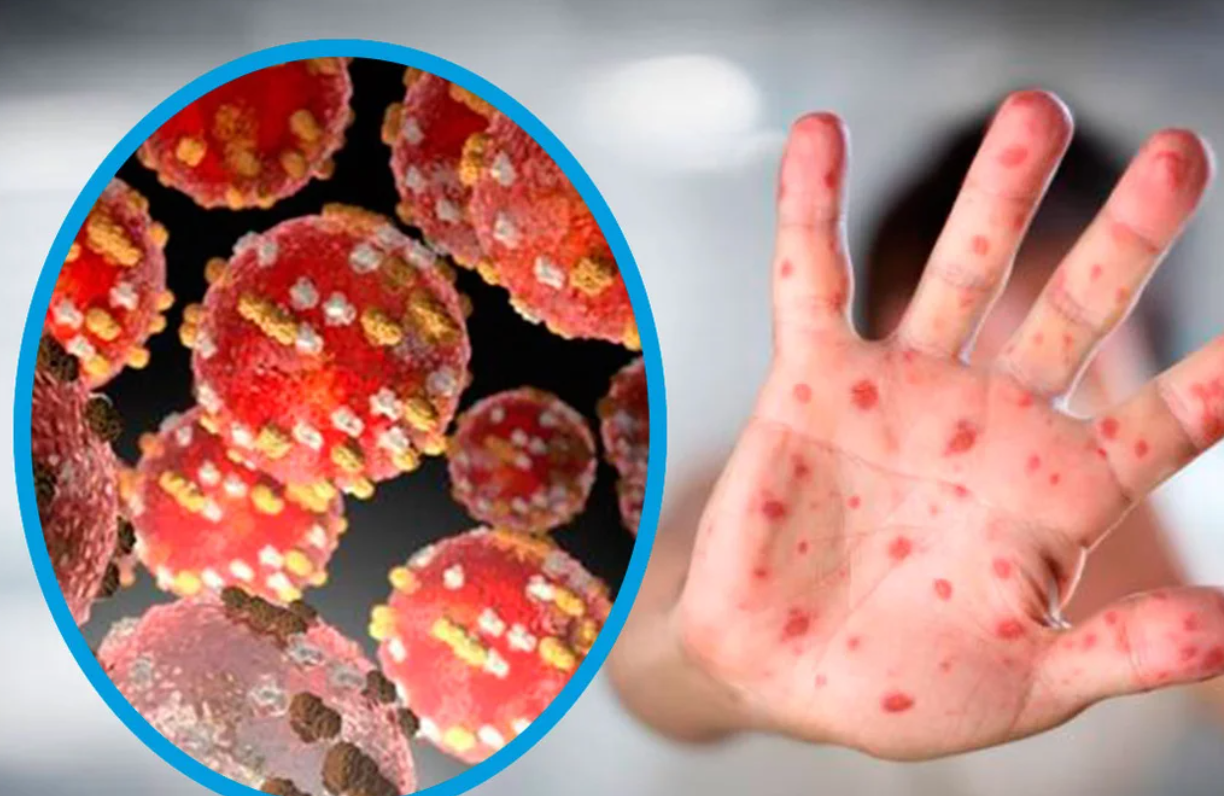 Reportaron 11 nuevos casos de la viruela del mono: siete en la Ciudad de Buenos Aires y el resto en la provincia | Información General