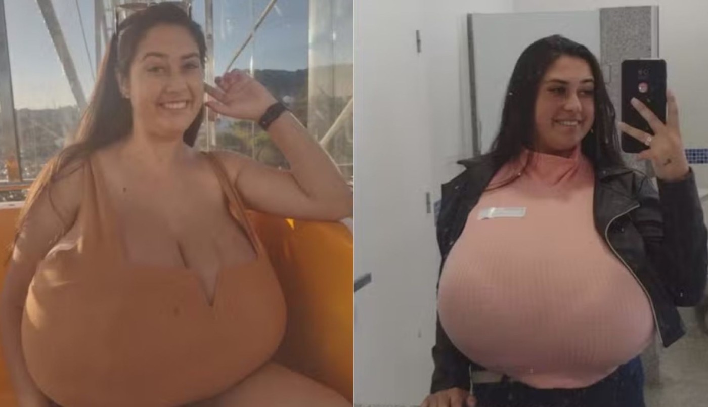 La pesadilla de vivir con gigantomastia: "Mis senos crecieron 10 kilos en unos meses, no aguanto más" | Internacionales