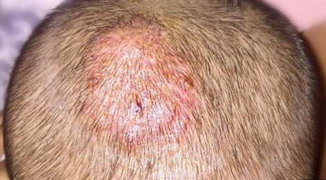 Se propaga una epidemia silenciosa de verano: cómo prevenir la tiña capilar | Información General